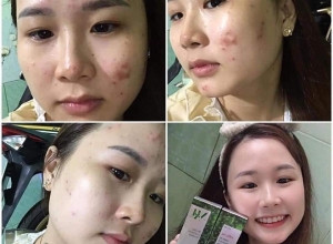  feedback trị mụn sau khi sử dụng sản phẩm Dr.Mai tại hệ thống https://drmaichinhhang.vn/