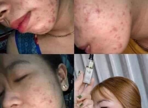  feedback trị mụn sau khi sử dụng sản phẩm Dr.Mai tại hệ thống https://drmaichinhhang.vn/