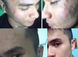  feedback trị mụn sau khi sử dụng sản phẩm Dr.Mai tại hệ thống https://drmaichinhhang.vn/