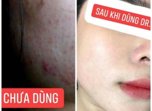  feedback trị mụn sau khi sử dụng sản phẩm Dr.Mai tại hệ thống https://drmaichinhhang.vn/