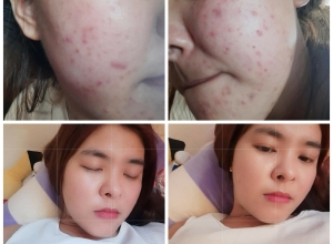  feedback trị mụn sau khi sử dụng sản phẩm Dr.Mai tại hệ thống https://drmaichinhhang.vn/