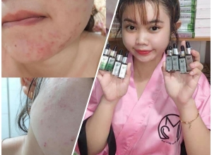  feedback trị mụn sau khi sử dụng sản phẩm Dr.Mai tại hệ thống https://drmaichinhhang.vn/