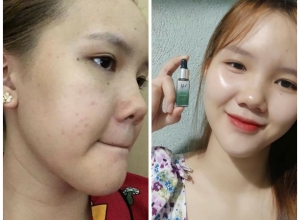  feedback trị mụn sau khi sử dụng sản phẩm Dr.Mai tại hệ thống https://drmaichinhhang.vn/