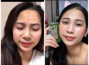  feedback trị mụn sau khi sử dụng sản phẩm Dr.Mai tại hệ thống https://drmaichinhhang.vn/