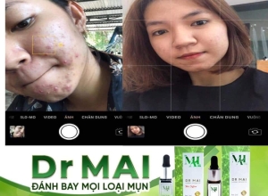  feedback trị mụn sau khi sử dụng sản phẩm Dr.Mai tại hệ thống https://drmaichinhhang.vn/