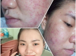  feedback trị mụn sau khi sử dụng sản phẩm Dr.Mai tại hệ thống https://drmaichinhhang.vn/