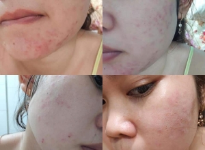  feedback trị mụn sau khi sử dụng sản phẩm Dr.Mai tại hệ thống https://drmaichinhhang.vn/