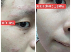  feedback trị mụn sau khi sử dụng sản phẩm Dr.Mai tại hệ thống https://drmaichinhhang.vn/