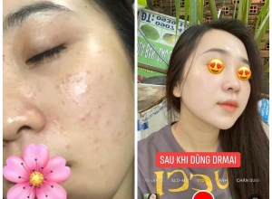  feedback trị mụn sau khi sử dụng sản phẩm Dr.Mai tại hệ thống https://drmaichinhhang.vn/