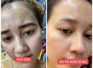  feedback trị mụn sau khi sử dụng sản phẩm Dr.Mai tại hệ thống https://drmaichinhhang.vn/