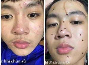  feedback trị mụn sau khi sử dụng sản phẩm Dr.Mai tại hệ thống https://drmaichinhhang.vn/