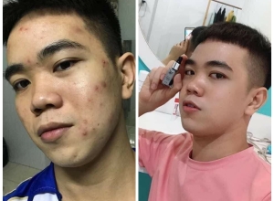  feedback trị mụn sau khi sử dụng sản phẩm Dr.Mai tại hệ thống https://drmaichinhhang.vn/