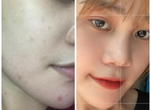  feedback trị mụn sau khi sử dụng sản phẩm Dr.Mai tại hệ thống https://drmaichinhhang.vn/