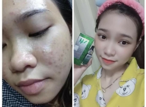  feedback trị mụn sau khi sử dụng sản phẩm Dr.Mai tại hệ thống https://drmaichinhhang.vn/