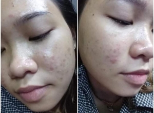  feedback trị mụn sau khi sử dụng sản phẩm Dr.Mai tại hệ thống https://drmaichinhhang.vn/