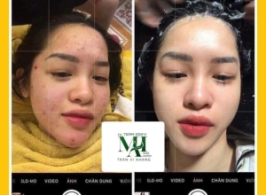  feedback trị mụn sau khi sử dụng sản phẩm Dr.Mai tại hệ thống https://drmaichinhhang.vn/