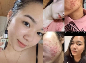  feedback trị mụn sau khi sử dụng sản phẩm Dr.Mai tại hệ thống https://drmaichinhhang.vn/