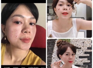  feedback trị mụn sau khi sử dụng sản phẩm Dr.Mai tại hệ thống https://drmaichinhhang.vn/