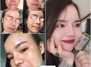  feedback trị mụn sau khi sử dụng sản phẩm Dr.Mai tại hệ thống https://drmaichinhhang.vn/