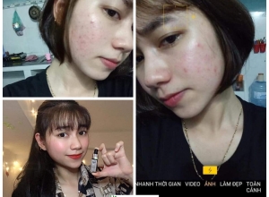  feedback trị mụn sau khi sử dụng sản phẩm Dr.Mai tại hệ thống https://drmaichinhhang.vn/