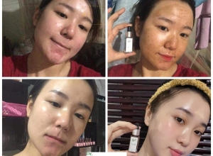  feedback trị mụn sau khi sử dụng sản phẩm Dr.Mai tại hệ thống https://drmaichinhhang.vn/