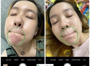  feedback trị mụn sau khi sử dụng sản phẩm Dr.Mai tại hệ thống https://drmaichinhhang.vn/