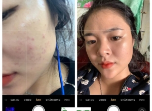  feedback trị mụn sau khi sử dụng sản phẩm Dr.Mai tại hệ thống https://drmaichinhhang.vn/