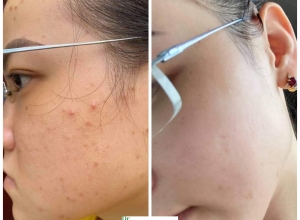  feedback trị mụn sau khi sử dụng sản phẩm Dr.Mai tại hệ thống https://drmaichinhhang.vn/