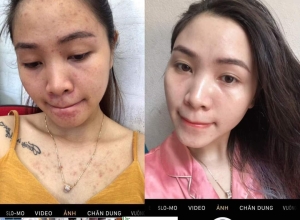  feedback trị mụn sau khi sử dụng sản phẩm Dr.Mai tại hệ thống https://drmaichinhhang.vn/