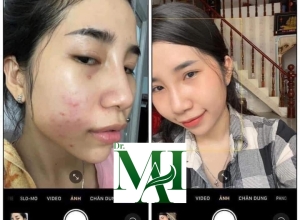  feedback trị mụn sau khi sử dụng sản phẩm Dr.Mai tại hệ thống https://drmaichinhhang.vn/