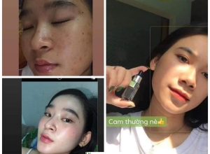  feedback trị mụn sau khi sử dụng sản phẩm Dr.Mai tại hệ thống https://drmaichinhhang.vn/