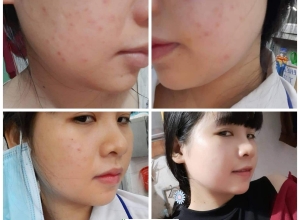  feedback trị mụn sau khi sử dụng sản phẩm Dr.Mai tại hệ thống https://drmaichinhhang.vn/