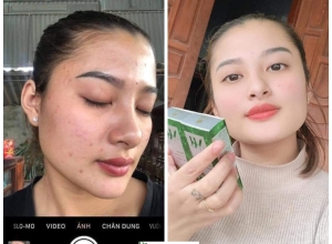  feedback trị mụn sau khi sử dụng sản phẩm Dr.Mai tại hệ thống https://drmaichinhhang.vn/