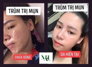  feedback trị mụn sau khi sử dụng sản phẩm Dr.Mai tại hệ thống https://drmaichinhhang.vn/