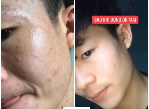  feedback trị mụn sau khi sử dụng sản phẩm Dr.Mai tại hệ thống https://drmaichinhhang.vn/