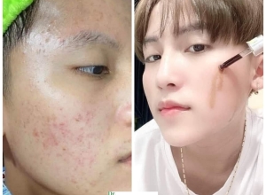  feedback trị mụn sau khi sử dụng sản phẩm Dr.Mai tại hệ thống https://drmaichinhhang.vn/