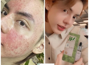  feedback trị mụn sau khi sử dụng sản phẩm Dr.Mai tại hệ thống https://drmaichinhhang.vn/