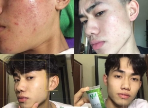  feedback trị mụn sau khi sử dụng sản phẩm Dr.Mai tại hệ thống https://drmaichinhhang.vn/