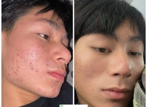  feedback trị mụn sau khi sử dụng sản phẩm Dr.Mai tại hệ thống https://drmaichinhhang.vn/