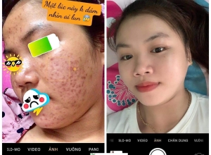  feedback trị mụn sau khi sử dụng sản phẩm Dr.Mai tại hệ thống https://drmaichinhhang.vn/