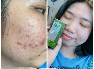  feedback trị mụn sau khi sử dụng sản phẩm Dr.Mai tại hệ thống https://drmaichinhhang.vn/