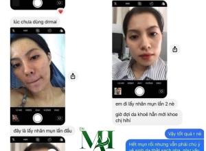  feedback trị mụn sau khi sử dụng sản phẩm Dr.Mai tại hệ thống https://drmaichinhhang.vn/