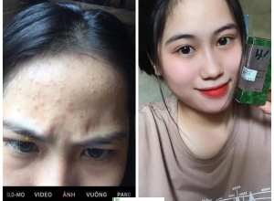  feedback trị mụn sau khi sử dụng sản phẩm Dr.Mai tại hệ thống https://drmaichinhhang.vn/