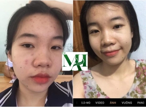  feedback trị mụn sau khi sử dụng sản phẩm Dr.Mai tại hệ thống https://drmaichinhhang.vn/