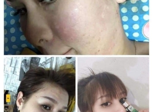  feedback trị mụn sau khi sử dụng sản phẩm Dr.Mai tại hệ thống https://drmaichinhhang.vn/