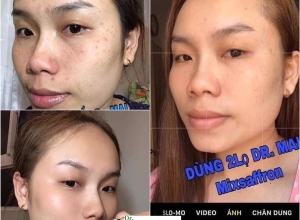  feedback trị mụn sau khi sử dụng sản phẩm Dr.Mai tại hệ thống https://drmaichinhhang.vn/