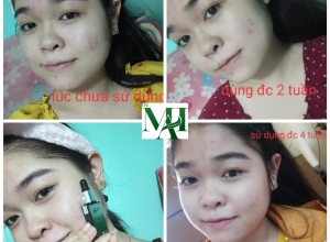  feedback trị mụn sau khi sử dụng sản phẩm Dr.Mai tại hệ thống https://drmaichinhhang.vn/