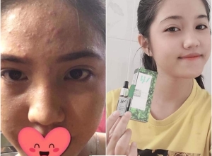  feedback trị mụn sau khi sử dụng sản phẩm Dr.Mai tại hệ thống https://drmaichinhhang.vn/