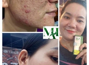  feedback trị mụn sau khi sử dụng sản phẩm Dr.Mai tại hệ thống https://drmaichinhhang.vn/