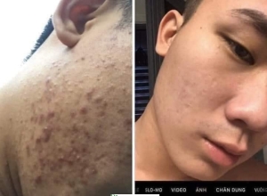  feedback trị mụn sau khi sử dụng sản phẩm Dr.Mai tại hệ thống https://drmaichinhhang.vn/